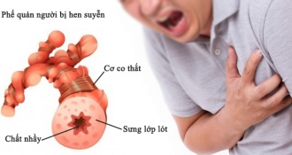 Hen phế quản là gì? Nguyên nhân, triệu chứng, cách phòng chống bệnh